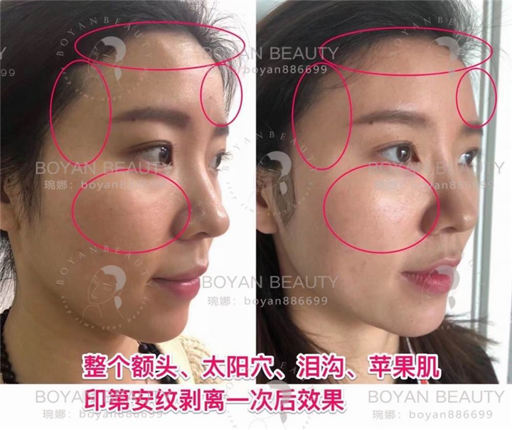 印第安纹剥离
