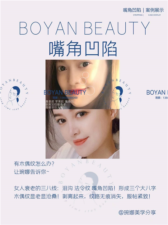 嘴角凹陷