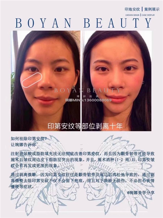 剥离微雕价格