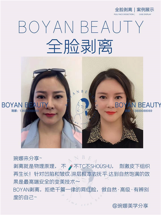 全脸剥离