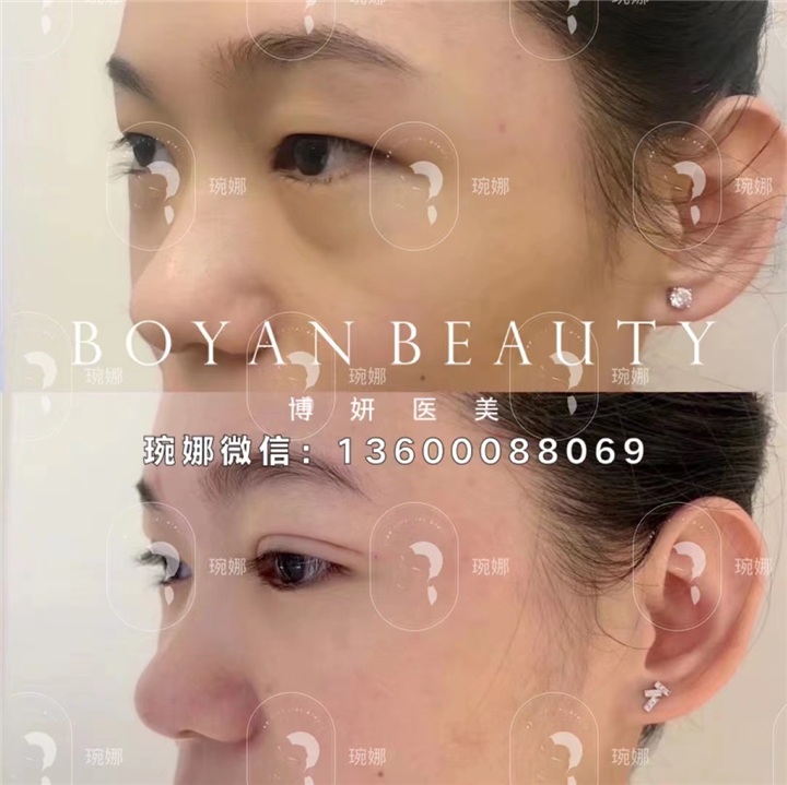 苹果肌下垂出现印第安纹