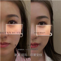 印第安纹怎么去除效果好