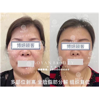 剥离微整费用