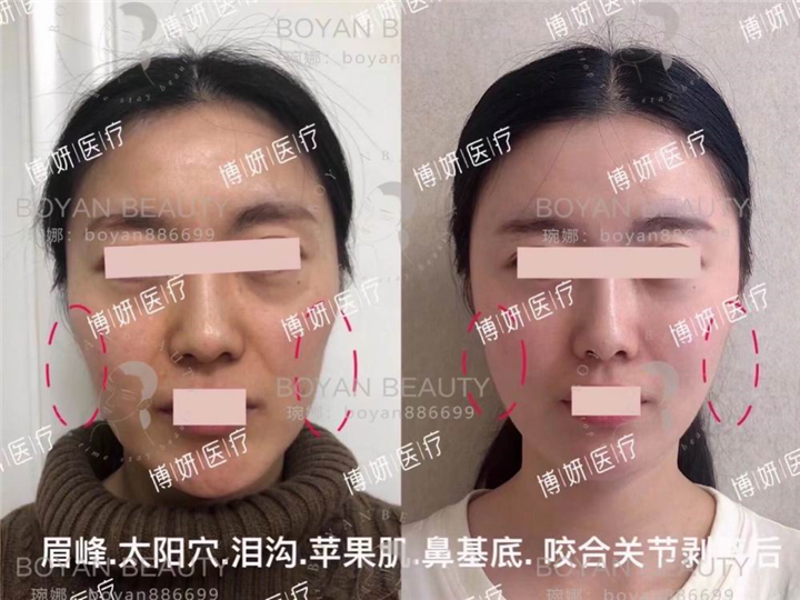 印第安纹剥离