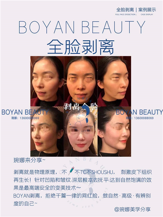 全脸剥离