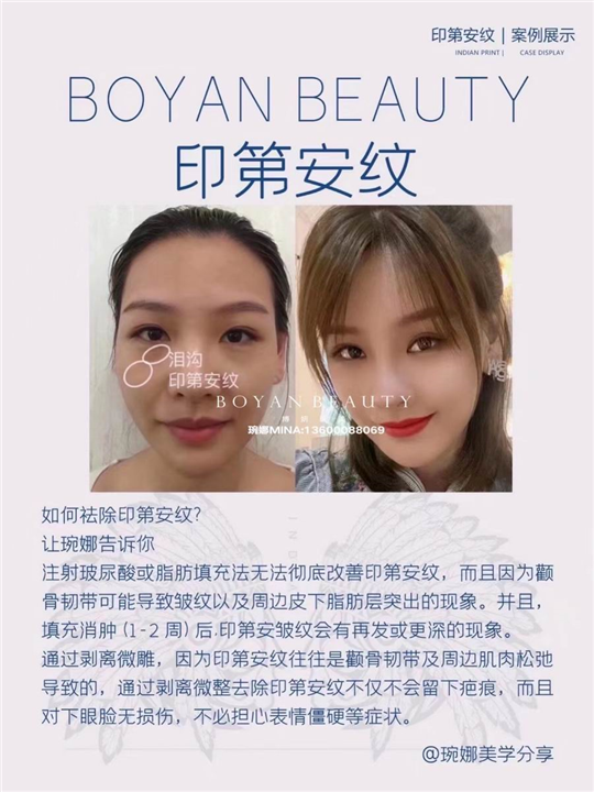 剥离微雕价格