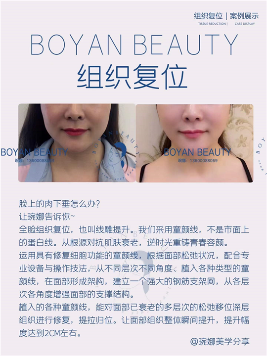 组织复位