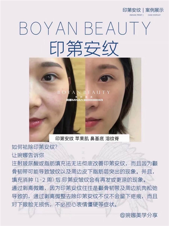 剥离微雕价格