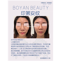 剥离微雕价格