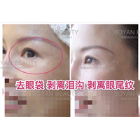 剥离眼角纹 