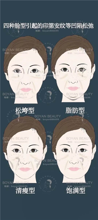 印第安纹剥离