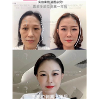 剥离微整