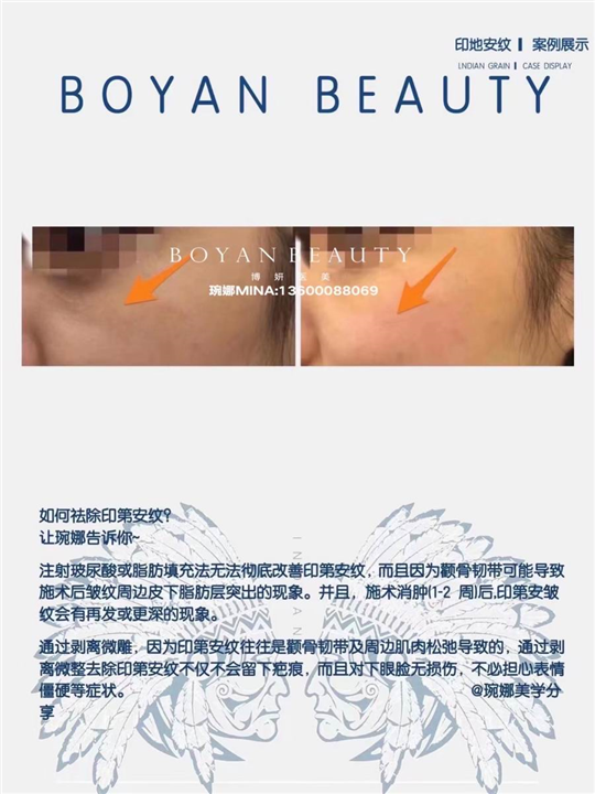 剥离微雕价格