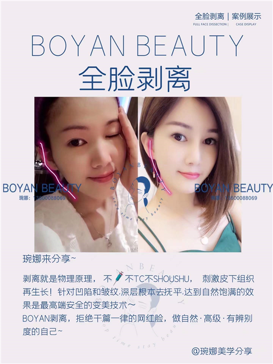 全脸剥离