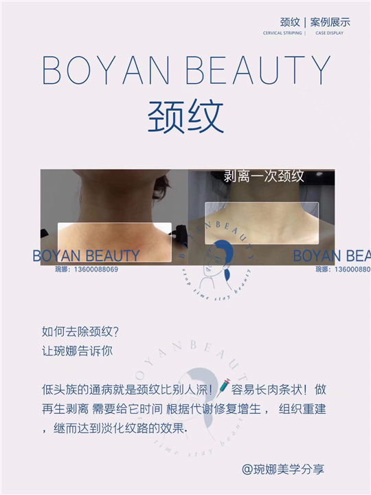 剥离颈纹
