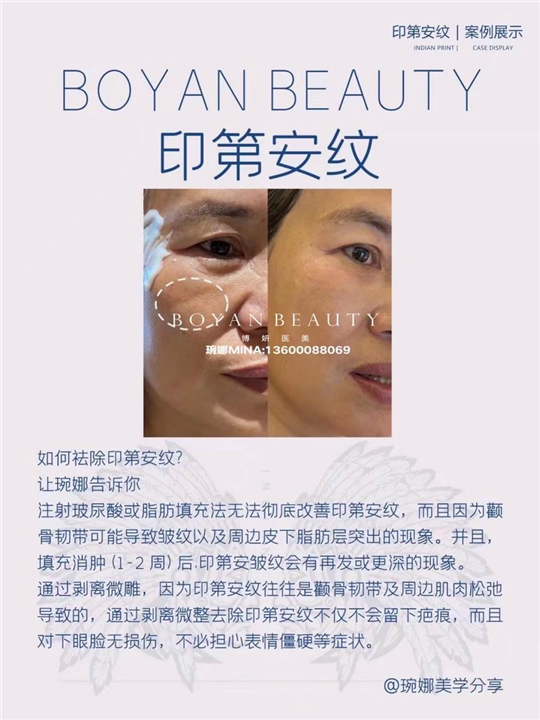 剥离微雕