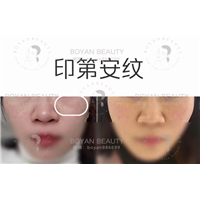 剥离微整