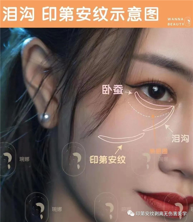 印第安纹怎么去除效果好？琬娜老师科普