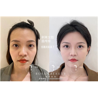 深圳剥离微整