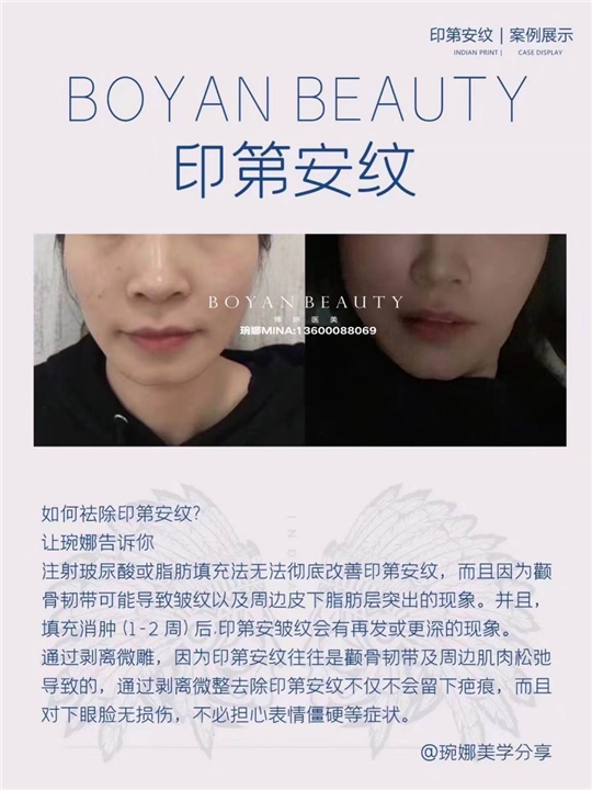 剥离微雕价格