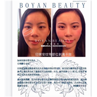 剥离微整