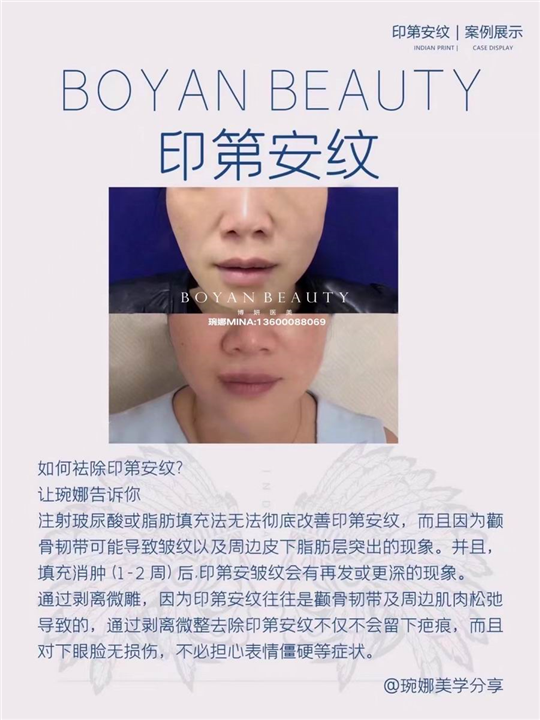 剥离微雕