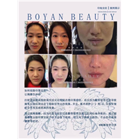 剥离微雕价格