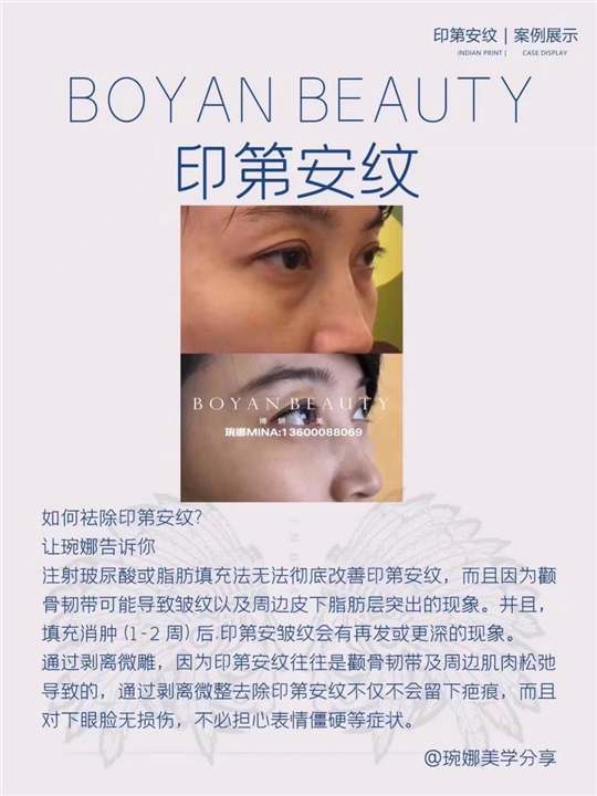 剥离微整费用