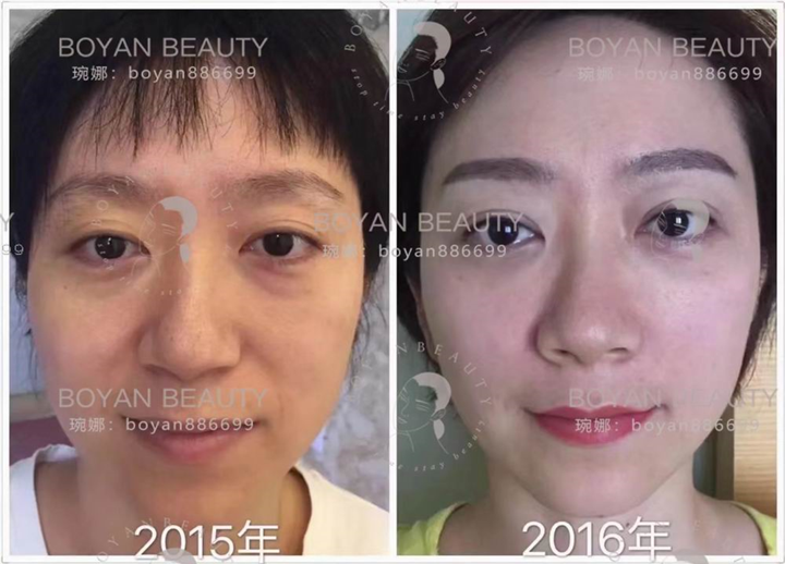 印第安纹剥离