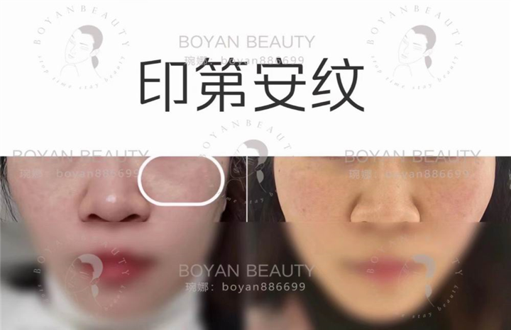 剥离微整