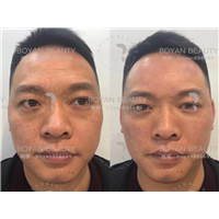 印第安纹剥离