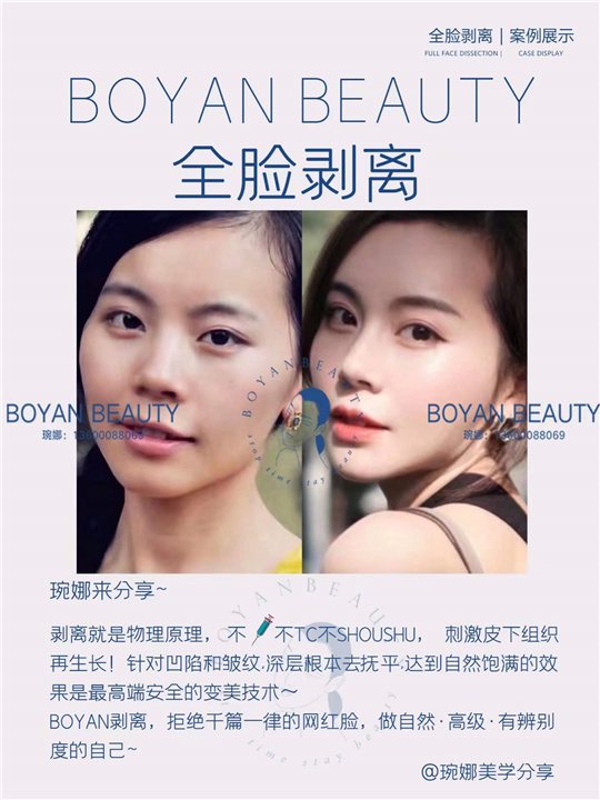 全脸剥离