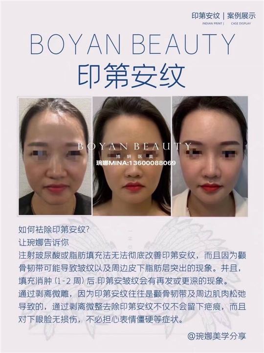 剥离微雕价格