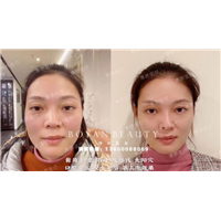 剥离微整费用