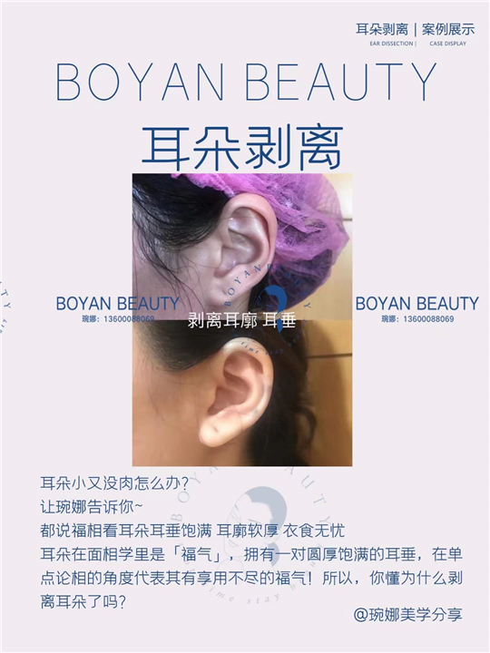 耳朵剥离