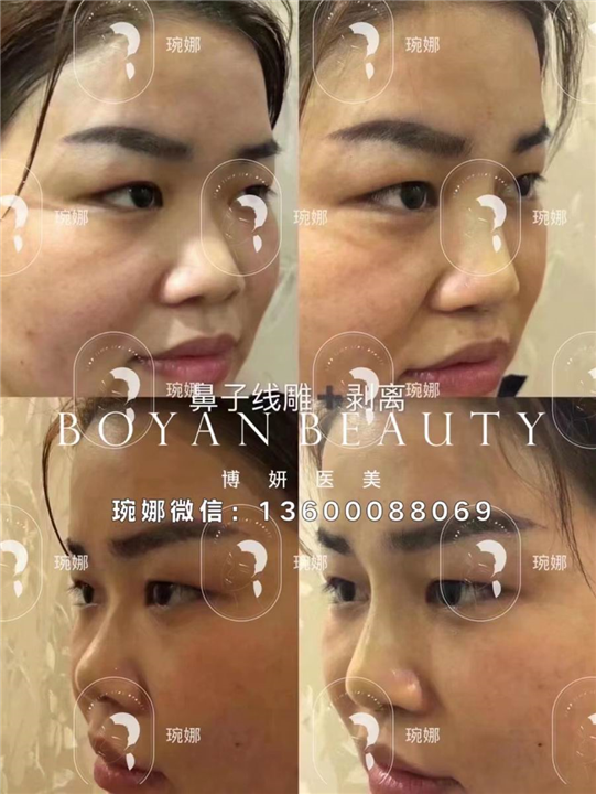 剥离微整费用