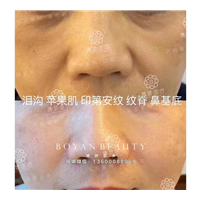 印第安纹一条默默让你显老的皱纹