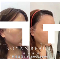北京印第安纹剥离手术哪里能做