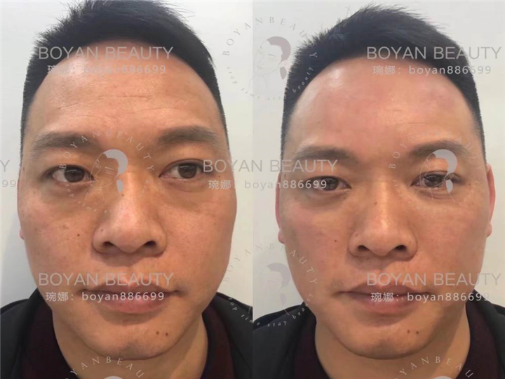 印第安纹剥离