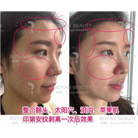 印第安纹剥离