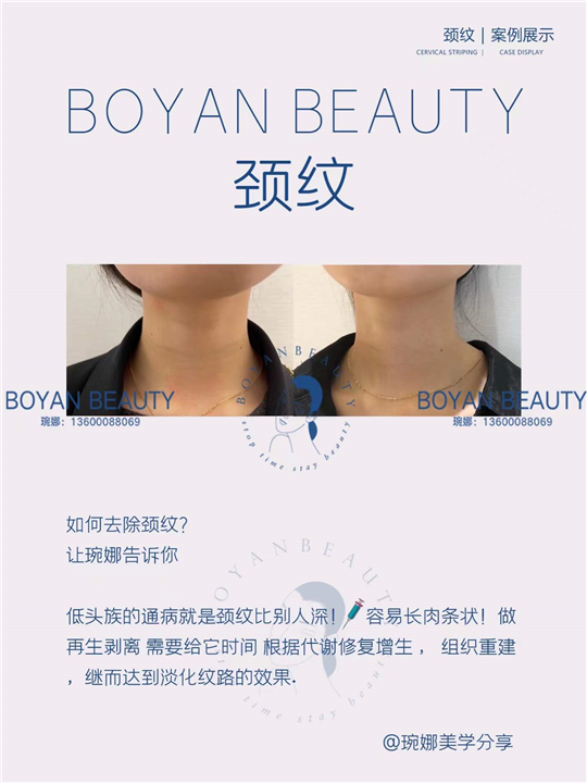 剥离颈纹