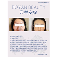 剥离微雕