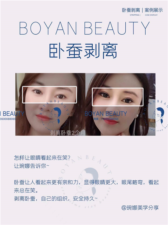 卧蚕剥离