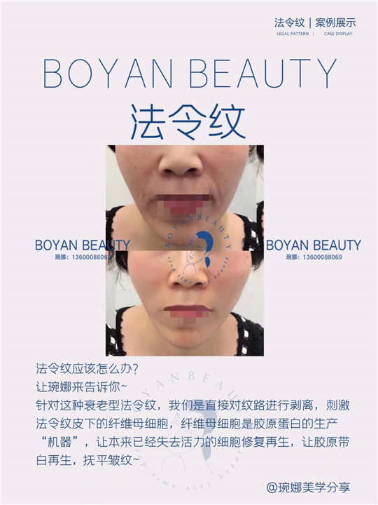 法令纹