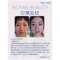 剥离微雕