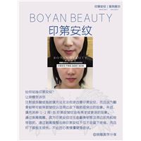 剥离微雕价格