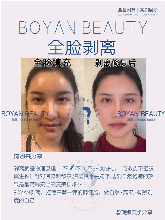 全脸剥离