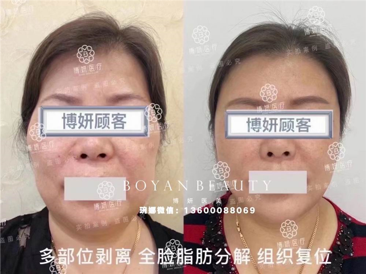 剥离微整费用