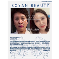 剥离微雕价格