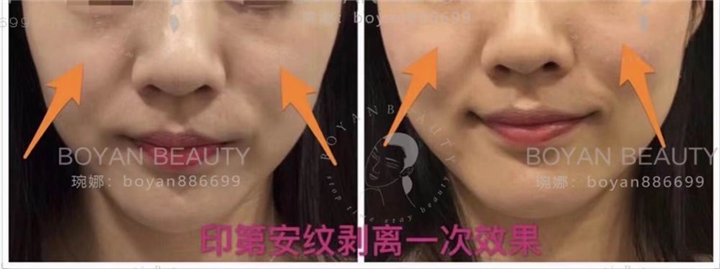 剥离微雕价格